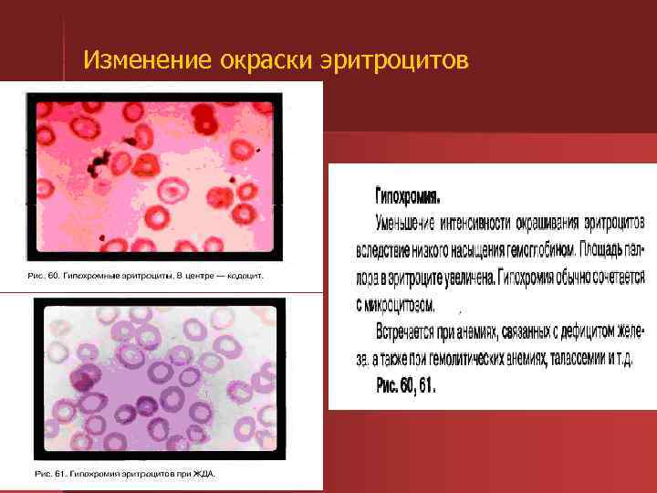 Изменение окраски эритроцитов 