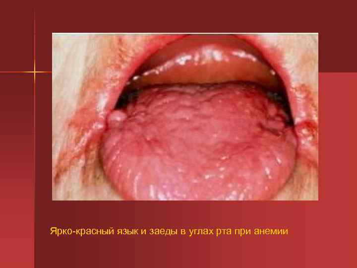 Ярко-красный язык и заеды в углах рта при анемии 