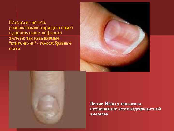 Патология ногтей, развивающаяся при длительно существующем дефиците железа: так называемые 