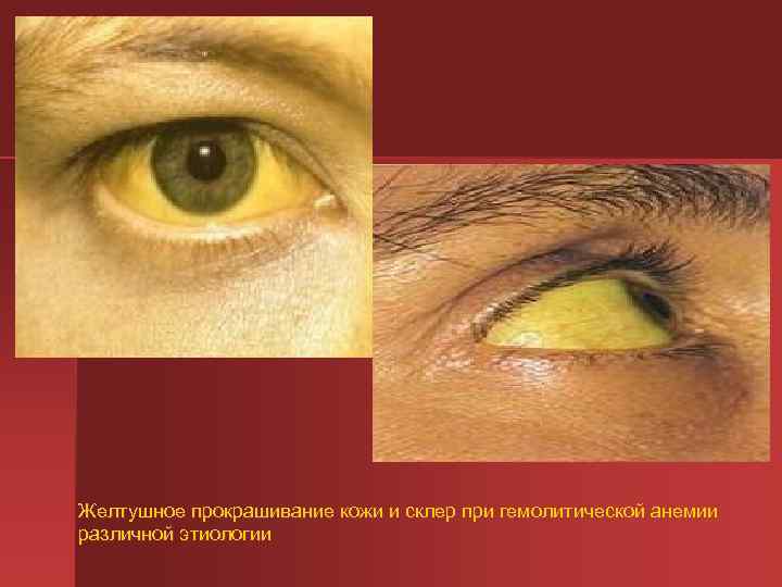 Желтушное прокрашивание кожи и склер при гемолитической анемии различной этиологии 