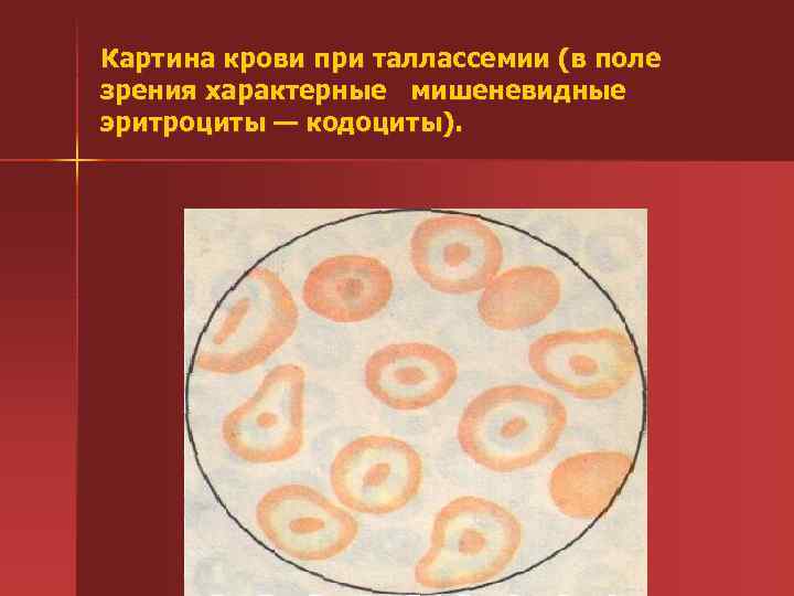 Картина крови при таллассемии (в поле зрения характерные мишеневидные эритроциты — кодоциты). 