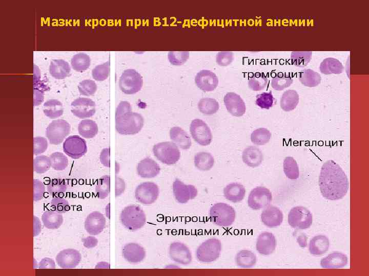 Мазки крови при В 12 дефицитной анемии 