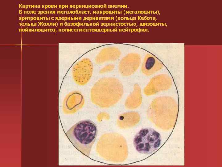 Картина крови при пернициозной анемии. В поле зрения мегалобласт, макроциты (мегалоциты), эритроциты с ядерными