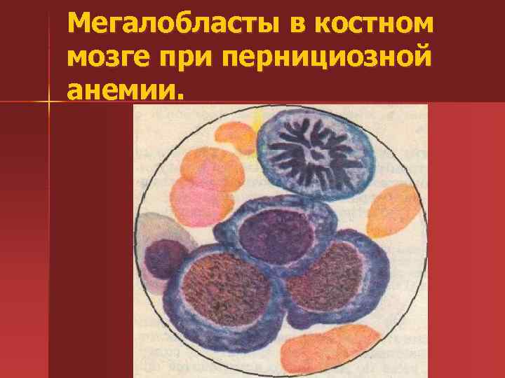 Мегалобласты в костном мозге при пернициозной анемии. 