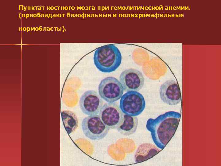Пунктат костного мозга при гемолитической анемии. (преобладают базофильные и полихромафильные нормобласты). 