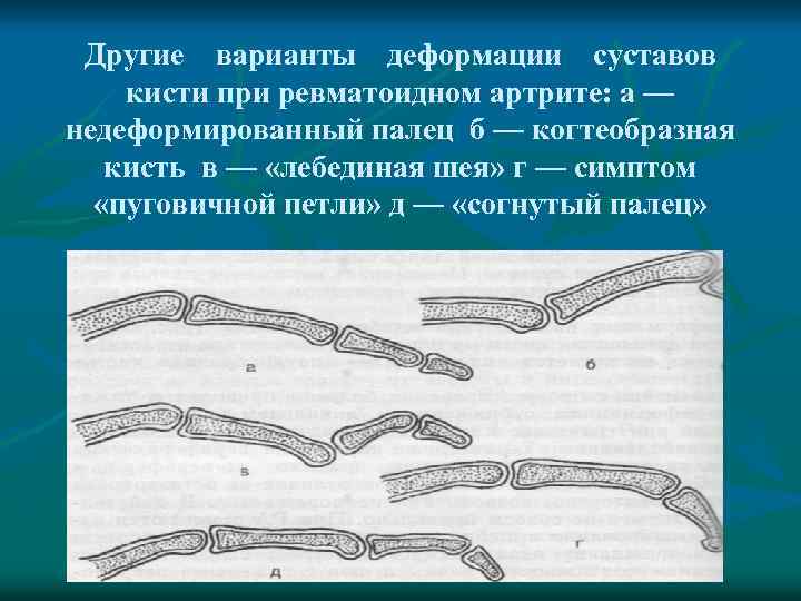 Другие варианты деформации суставов кисти при ревматоидном артрите: а — недеформированный палец б —