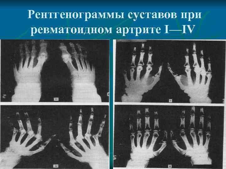 Рентгенограммы суставов при ревматоидном артрите I—IV 