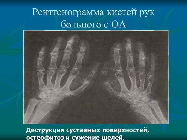 Рентгенограмма кистей рук больного с ОА Деструкция суставных поверхностей, остеофитоз и сужение щелей. 