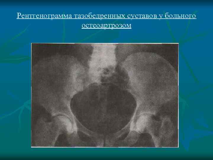 Рентгенограмма тазобедренных суставов у больного остеоартрозом 