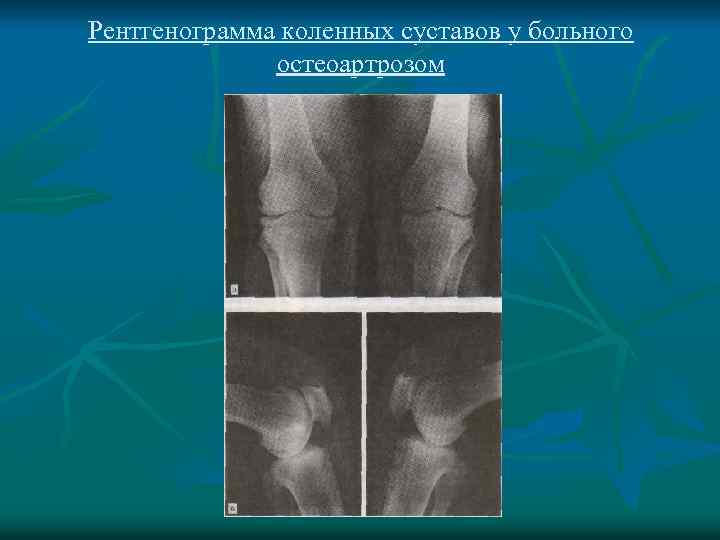 Рентгенограмма коленных суставов у больного остеоартрозом 