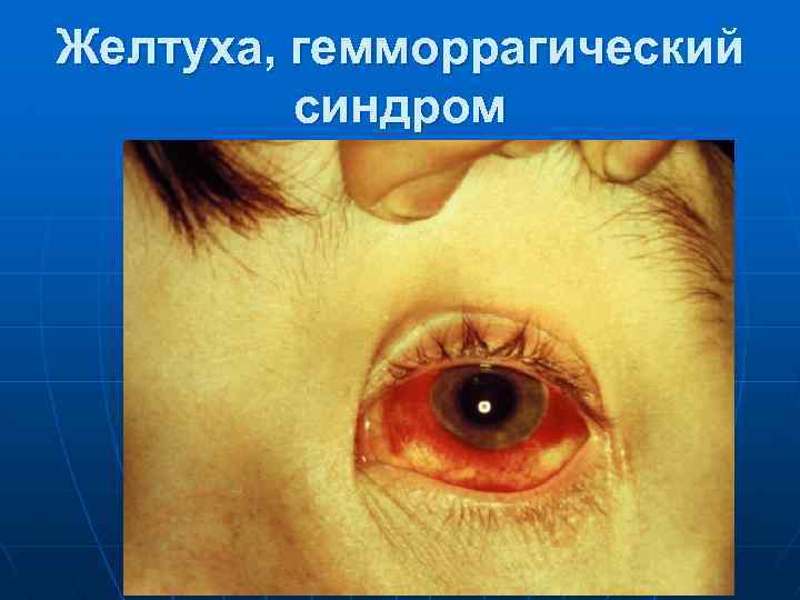 Желтуха, гемморрагический синдром 