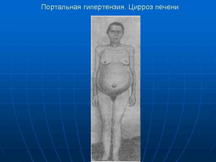Портальная гипертензия. Цирроз печени 