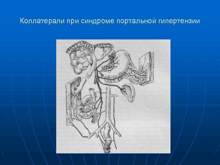 Коллатерали при синдроме портальной гипертензии 