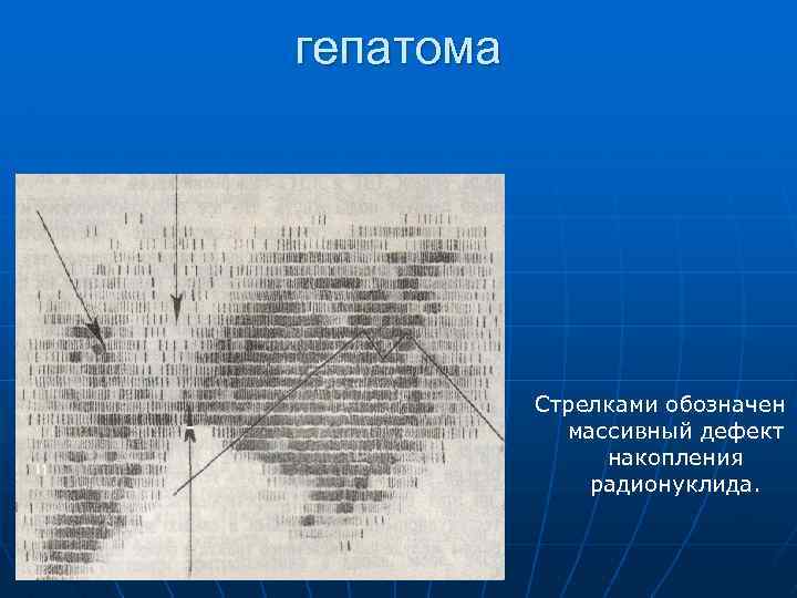 гепатома Стрелками обозначен массивный дефект накопления радионуклида. 