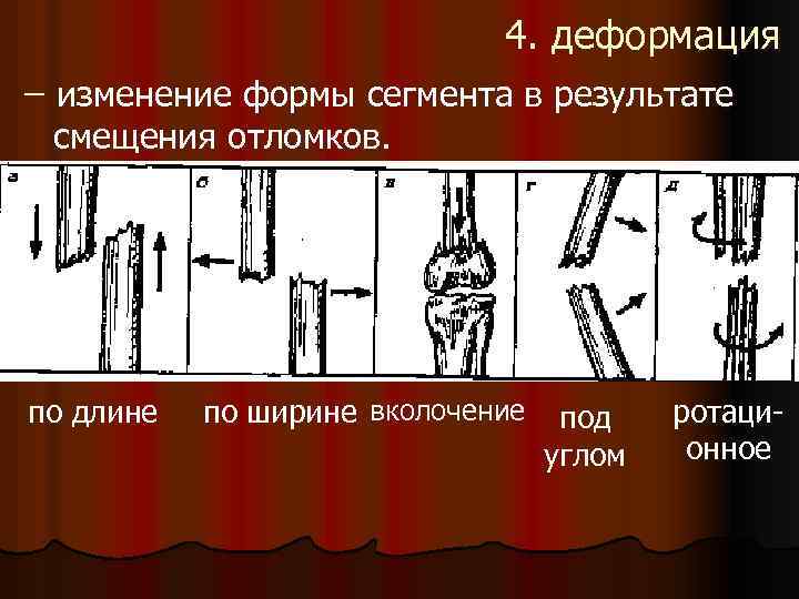 4. деформация изменение формы сегмента в результате смещения отломков. по длине по ширине вколочение