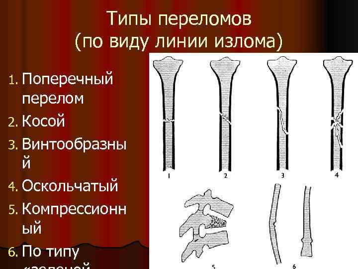 Поперечный перелом. Классификация переломов по линии излома. Поперечные косые винтообразные переломы.