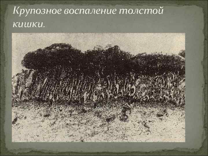 Крупозное воспаление толстой кишки. 