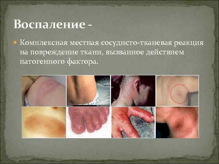 Воспаление Комплексная местная сосудисто-тканевая реакция на повреждение ткани, вызванное действием патогенного фактора. 