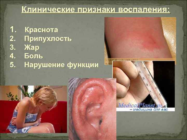 Клинические признаки воспаления: 1. Краснота 2. 3. 4. 5. Припухлость Жар Боль Нарушение функции
