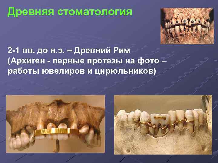 Древняя стоматология 2 -1 вв. до н. э. – Древний Рим (Архиген - первые