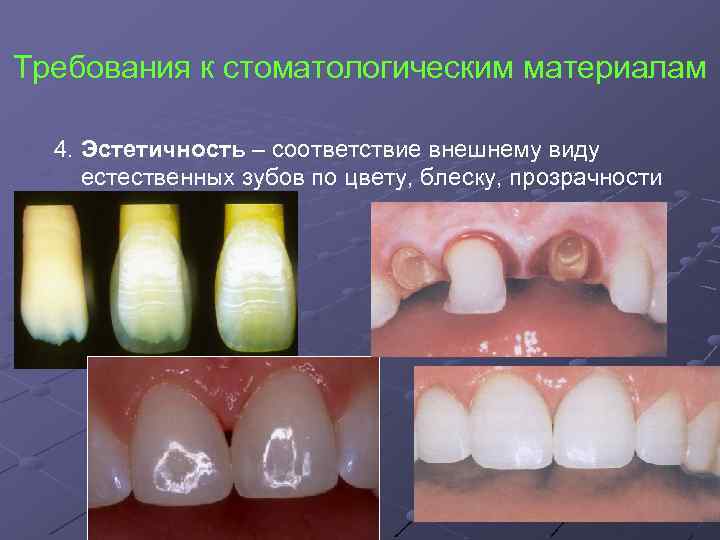 Требования к стоматологическим материалам 4. Эстетичность – соответствие внешнему виду естественных зубов по цвету,