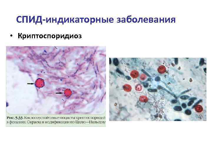СПИД-индикаторные заболевания • Криптоспоридиоз 