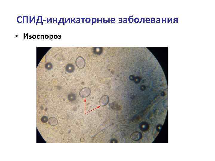СПИД-индикаторные заболевания • Изоспороз 