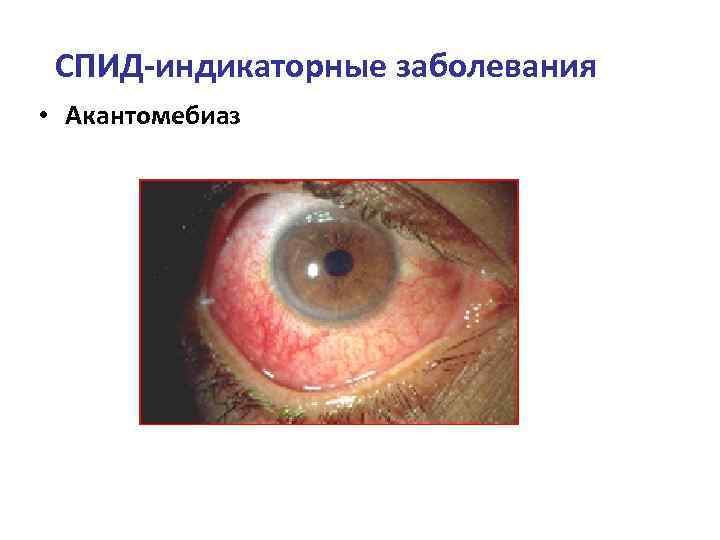 СПИД-индикаторные заболевания • Акантомебиаз 