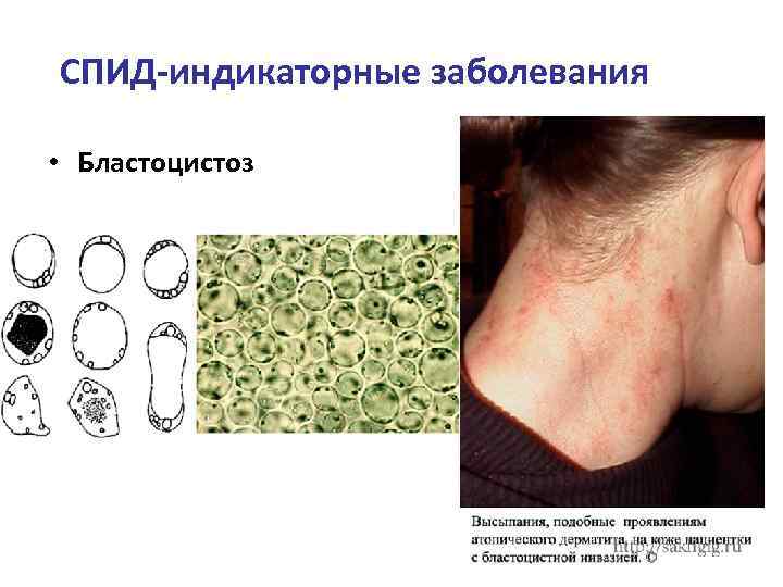 СПИД-индикаторные заболевания • Бластоцистоз 