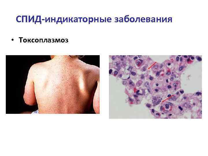 СПИД-индикаторные заболевания • Токсоплазмоз 