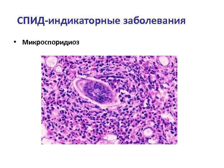 СПИД-индикаторные заболевания • Микроспоридиоз 