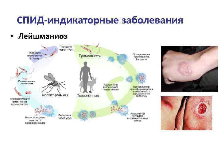 СПИД-индикаторные заболевания • Лейшманиоз 