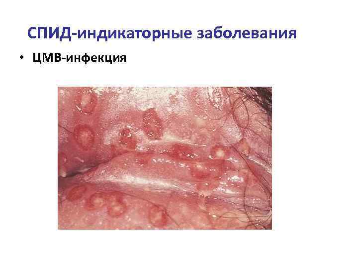СПИД-индикаторные заболевания • ЦМВ-инфекция 