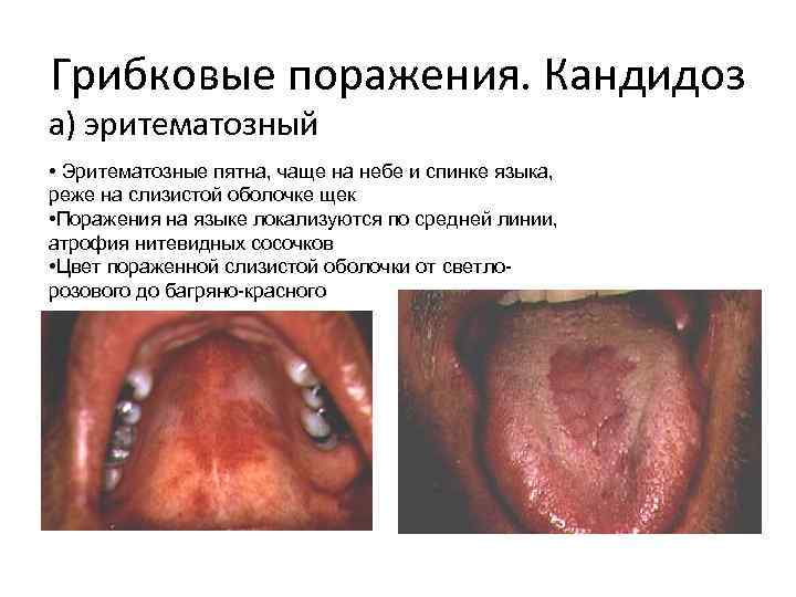 Грибковые поражения. Кандидоз а) эритематозный • Эритематозные пятна, чаще на небе и спинке языка,