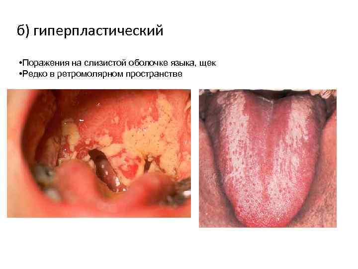 б) гиперпластический • Поражения на слизистой оболочке языка, щек • Редко в ретромолярном пространстве