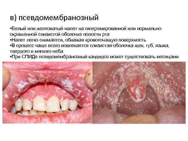 в) псевдомембранозный • Белый или желтоватый налет на гиперемированной или нормально окрашенной слизистой оболочке