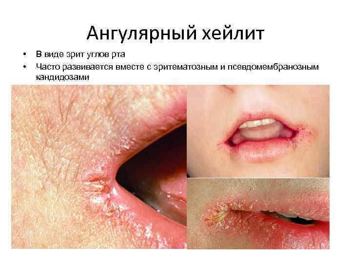 Ангулярный хейлит • • В виде эрит углов рта Часто развивается вместе с эритематозным