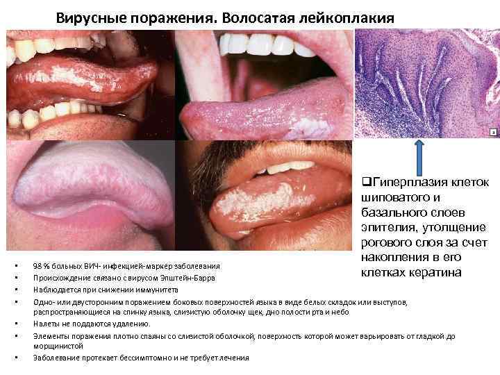 Вирусные поражения. Волосатая лейкоплакия • • q. Гиперплазия клеток шиповатого и базального слоев эпителия,