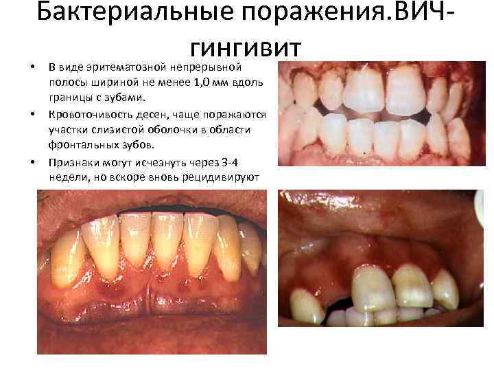 Бактериальные поражения. ВИЧгингивит • В виде эритематозной непрерывной • • полосы шириной не менее