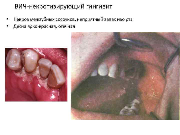 ВИЧ-некротизирующий гингивит • Некроз межзубных сосочков, неприятный запах изо рта • Десна ярко-красная, отечная