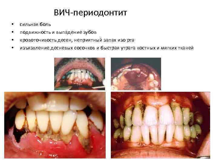 ВИЧ-периодонтит • • сильная боль подвижность и выпадение зубов кровоточивость десен, неприятный запах изо