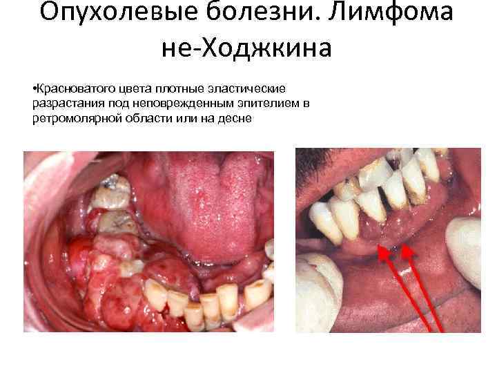 Опухолевые болезни. Лимфома не-Ходжкина • Красноватого цвета плотные эластические разрастания под неповрежденным эпителием в