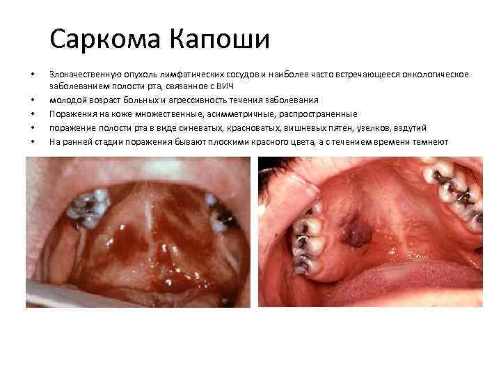 Саркома Капоши • • • Злокачественную опухоль лимфатических сосудов и наиболее часто встречающееся онкологическое