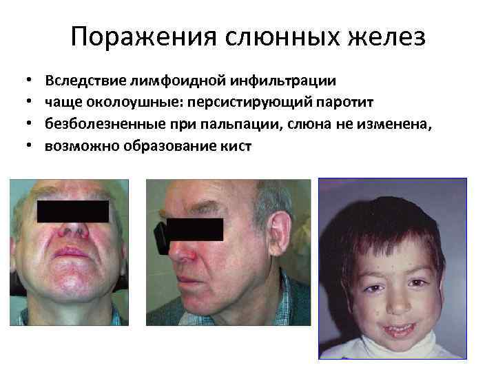 Поражения слюнных желез • • Вследствие лимфоидной инфильтрации чаще околоушные: персистирующий паротит безболезненные при