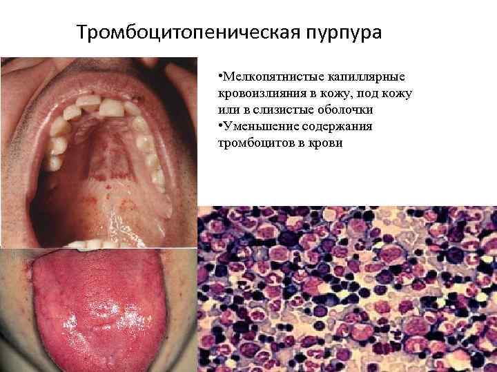 Тромбоцитопеническая пурпура • Мелкопятнистые капиллярные кровоизлияния в кожу, под кожу или в слизистые оболочки