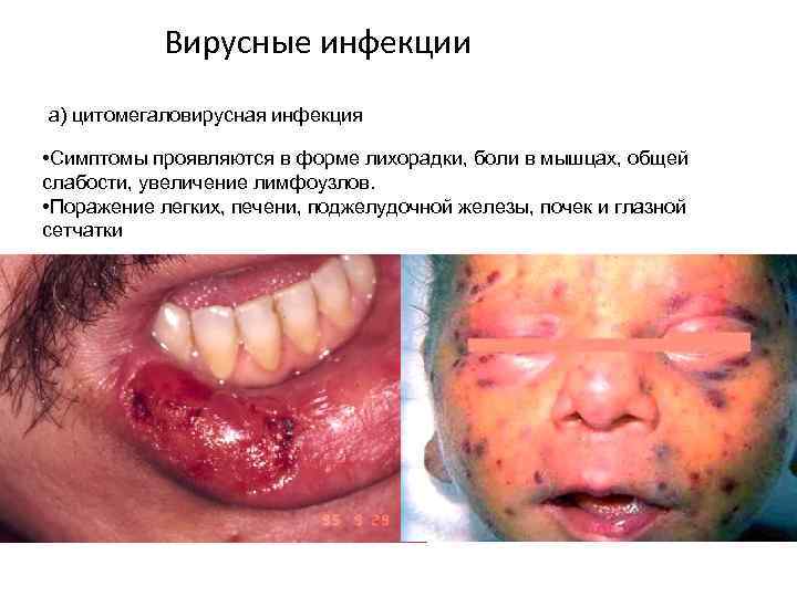 Вирусные инфекции а) цитомегаловирусная инфекция • Симптомы проявляются в форме лихорадки, боли в мышцах,