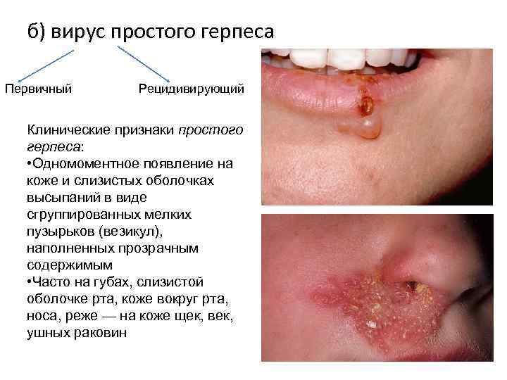 б) вирус простого герпеса Первичный Рецидивирующий Клинические признаки простого герпеса: • Одномоментное появление на