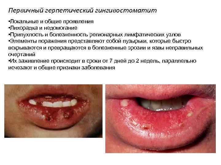 Первичный герпетический гингивостоматит • Локальные и общие проявления • Лихорадка и недомогание • Припухлость