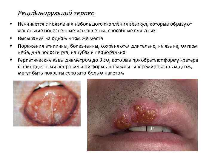Рецидивирующий герпес • • Начинается с появления небольшого скопления везикул, которые образуют маленькие болезненные