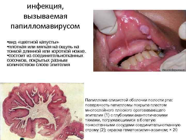 инфекция, вызываемая папилломавирусом • вид «цветной капусты» • плотная или мягкая на ощупь на